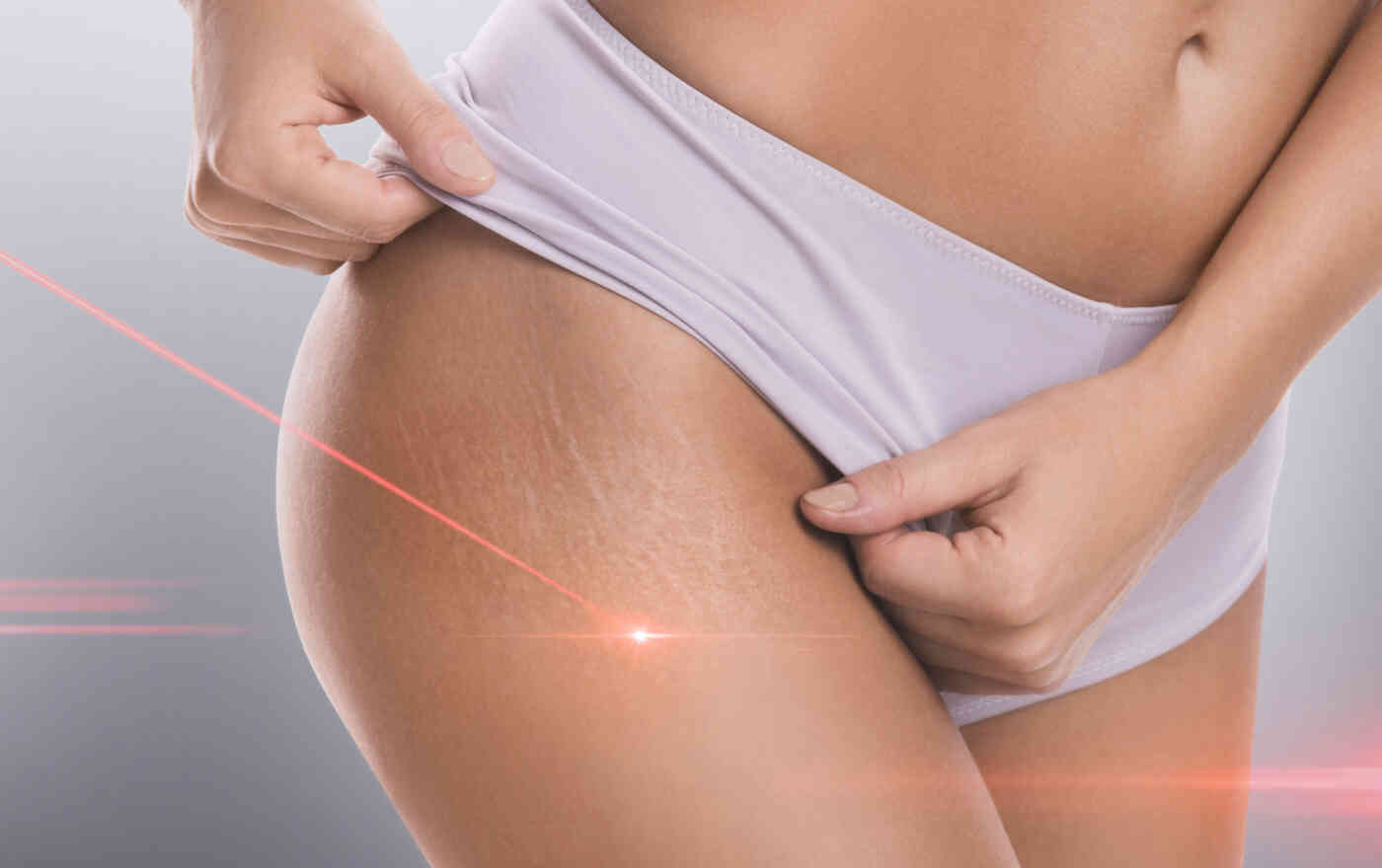 Schwangerschafts- und Dehnungsstreifen mit dem Laser entfernen