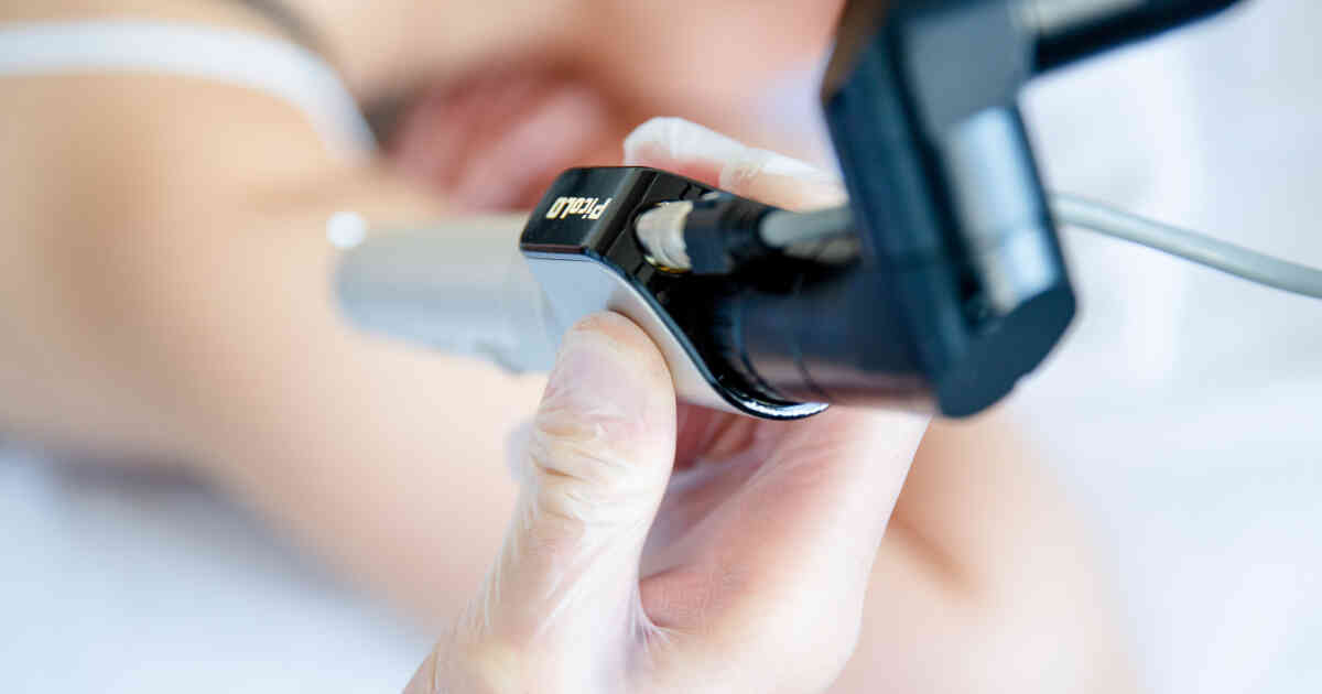 Tattoo entfernen mit Laser Preise und Beratung