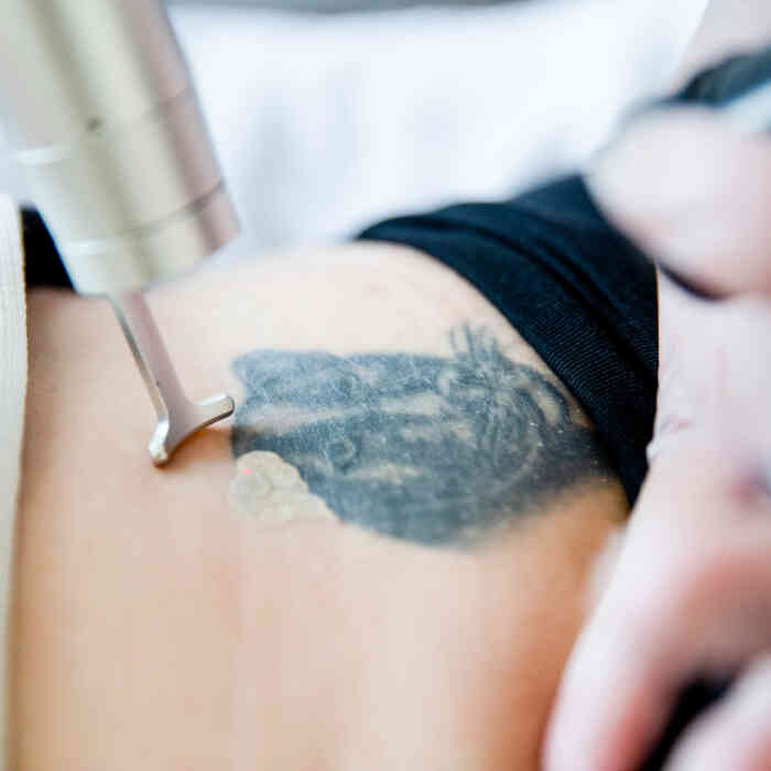 Tattoentfernung bei Tattgo mit Lasertherapie