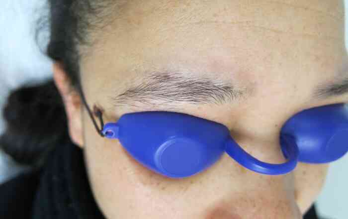 Entfernung von Permanent Make-up Augenbrauen nach der Behandlung