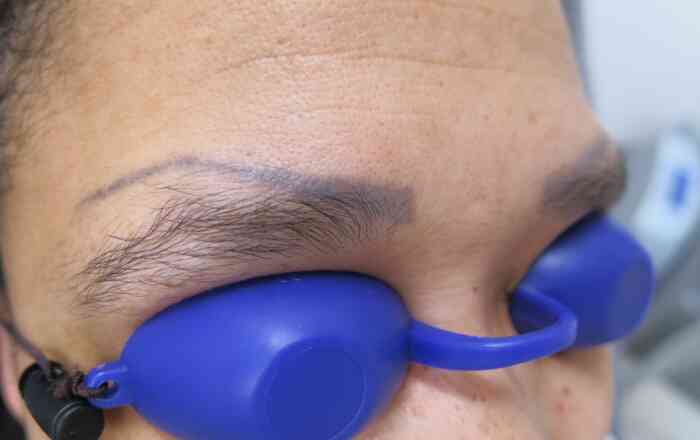 Entfernung von Permanent Make-up Augenbrauen vor der Behandlung